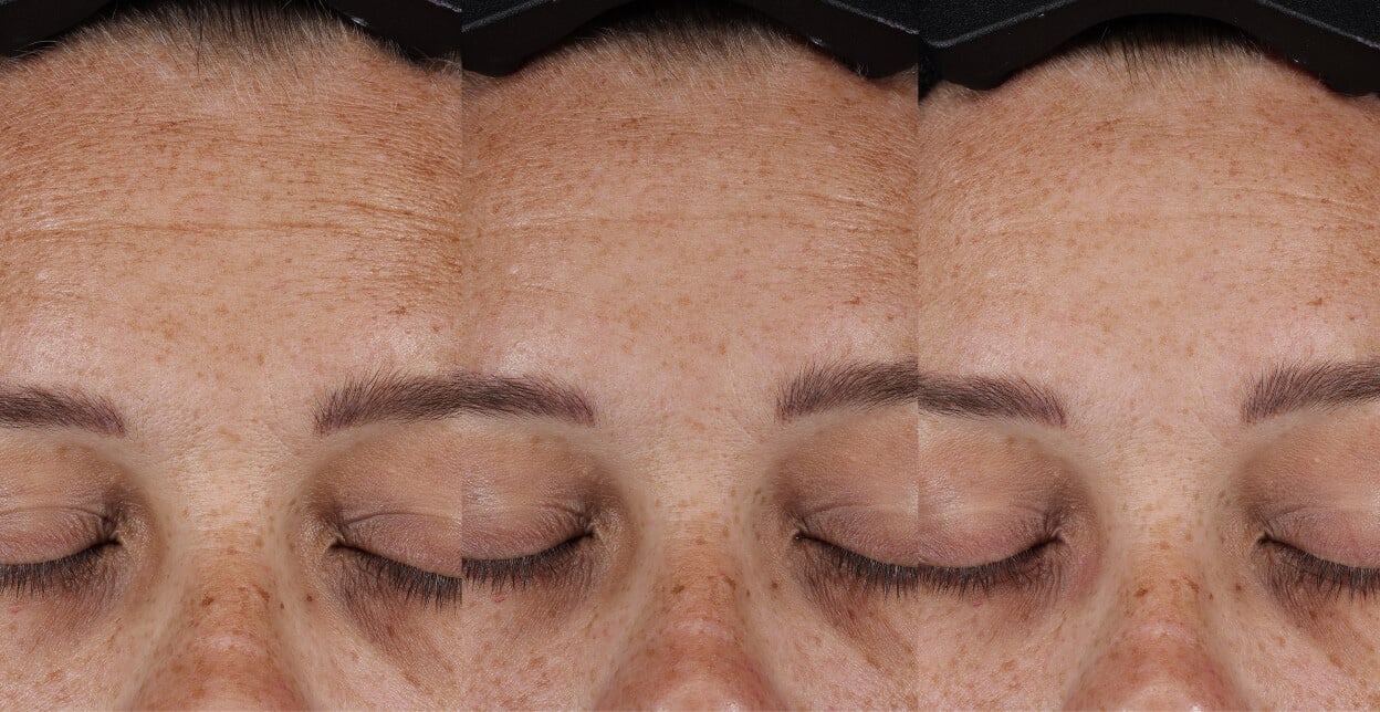 Clinical Pro Retinaldehyde Dual-Retinoid Treatment - Двойна Ретиноидна Терапия