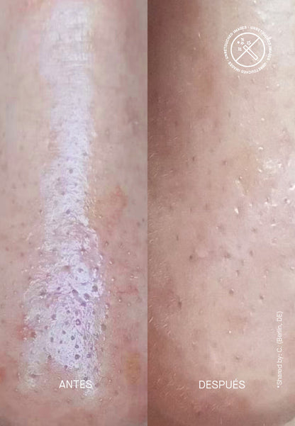 Zitproof® Nose - Пачове Против Черни Точки по Носа