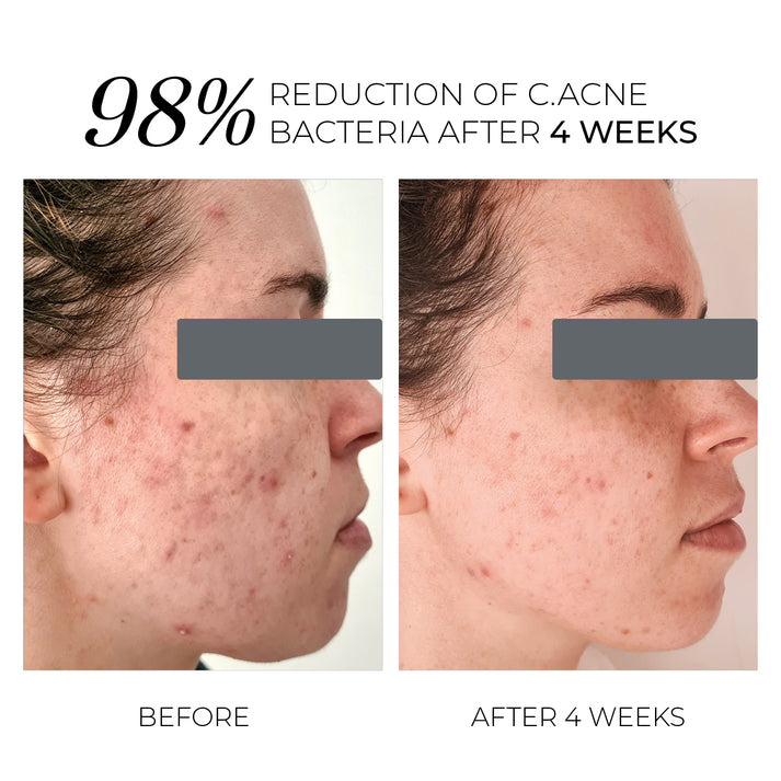 Violet Water D-Spot - Локална Терапия за Изсушаване на Пъпки