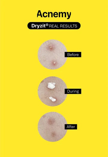 DRYZIT®- локален серум за изсушаване на пъпки