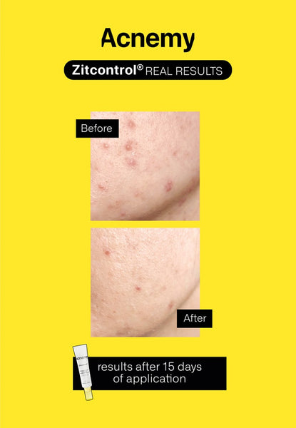 ZITCONTROL® - нощен крем за акнеична кожа